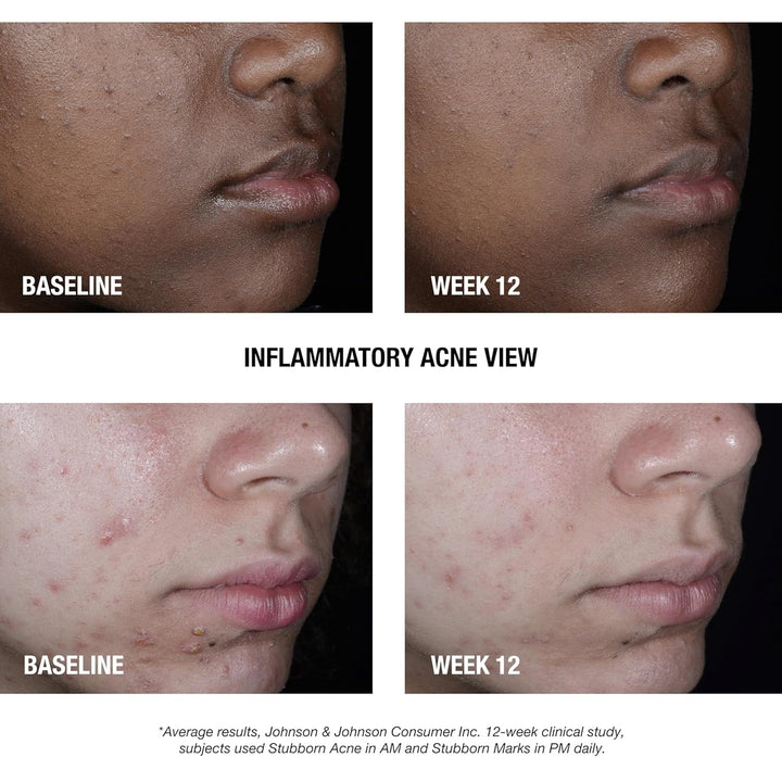 Neutrogena Stubborn Acne AM Face Treatment with 2.5% Micronized Benzoyl Peroxide - 56g