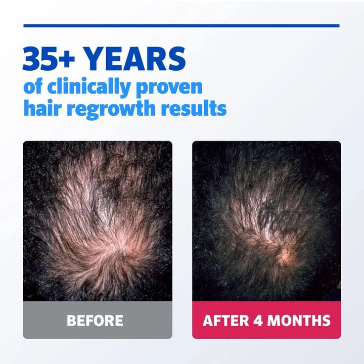 Men's Rogaine Extra Strength 5% Minoxidil Topical Solution, 1-Month