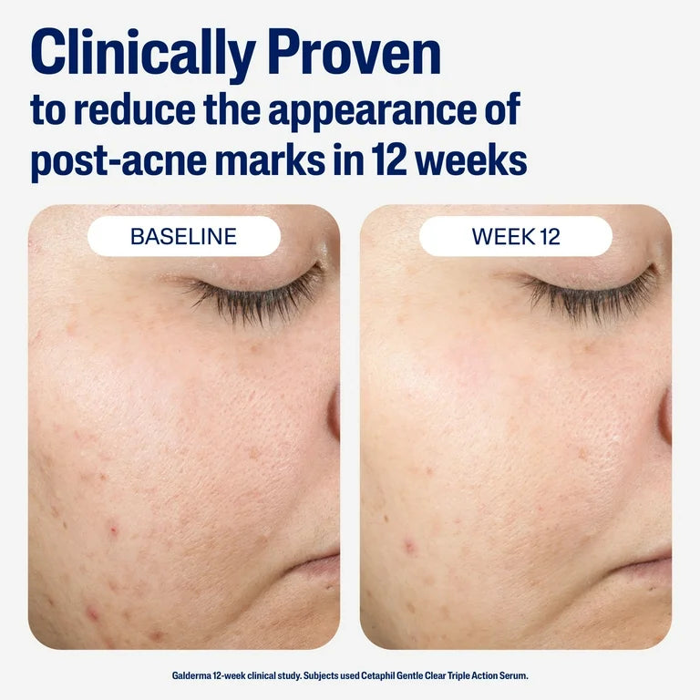 Cetaphil Acne Gentle Clear Repairing Post-Acne Serum, 0.5% Bakuchiol, 1 OZ