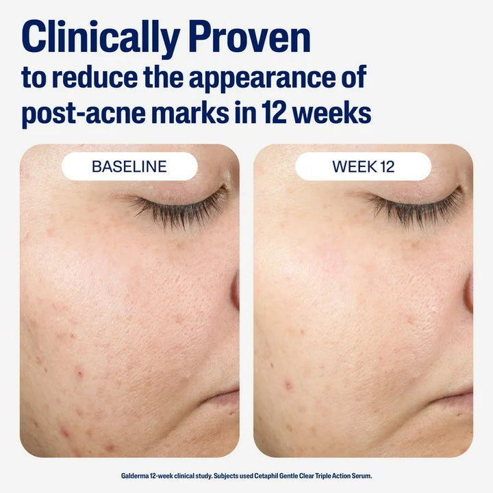 Cetaphil Acne Gentle Clear Repairing Post-Acne Serum, 0.5% Bakuchiol, 1 OZ